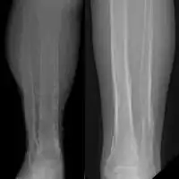 Periosteal reaction from venous stasis