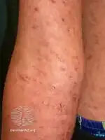 Pityriasis lichenoides chronica