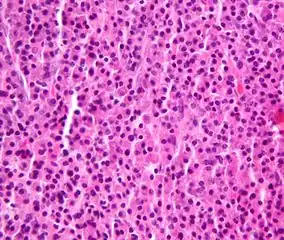 Plasmacytoma, H&E stain