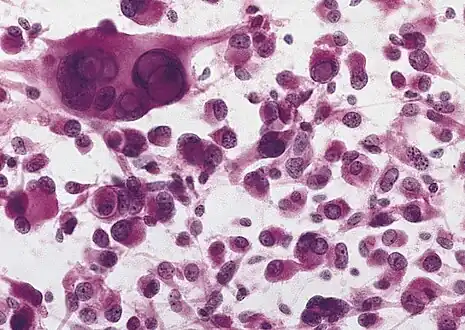 Pleomorphic xanthoastrocytoma, as visualized under a microscope