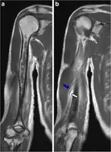 MRI pneumococcal osteomyelitis