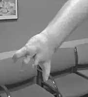 Right hand symbrachydactyly in Poland syndrome