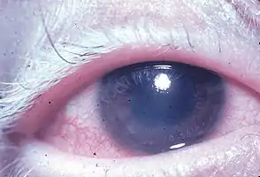 Uveitis with poliosis of the eyelashes
