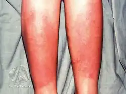 Pretibial myxoedema in Graves disease
