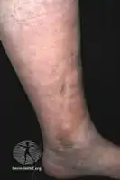 Pretibial myxoedema in Graves disease