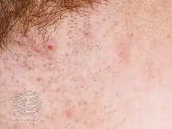 Pseudofolliculitis barbae
