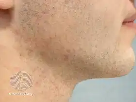 Pseudofolliculitis barbae