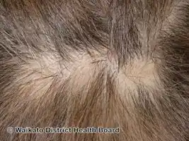 Pseudopelade of Brocq