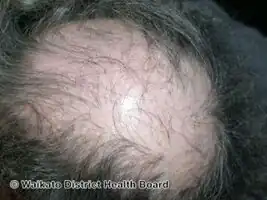 Pseudopelade of Brocq