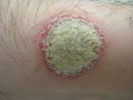 Psoriatic plaque, showing a silvery center surrounded by a reddened border.