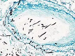 Angioinvasive pulmonary aspergillosis