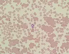 A photomicrograph of a blood smear showing red blood cells in clumps