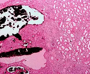 Micrograph of a renal oncocytoma. H&E stain.