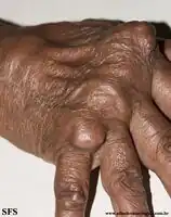 Rheumatoid arthritis