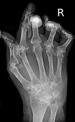 X-ray of the hand in rheumatoid arthritis.