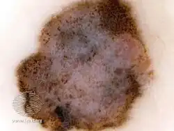 Ridge pattern, asymmetry of structures and colours