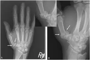 'Y-shaped' Rolanda fracture