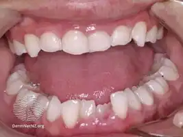 Rothmund-Thomson syndrome