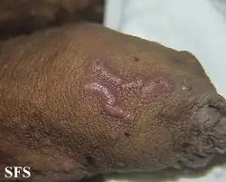 Burrow in scabies