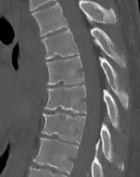 Scheuermann's disease on lateral CT of the T spine