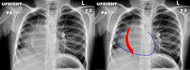 Chest x-ray of a five-year-old girl with Scimitar syndrome.  The heart (blue outline) is shifted into the right half of the chest, and the anomalous pulmonary venous return (red) has a shape reminiscent of a Scimitar.