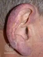 Secondary acrocyanosis