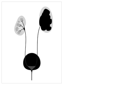 Pelvi-ureteric junction obstruction - easily mistaken for cystic renal disease on early scans