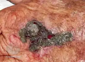 Silver nitrate chemical cautery