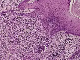 Eccrine clear-cell poroma