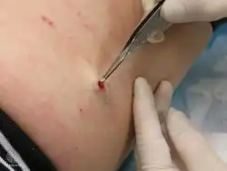 Skin biopsy for histopathology