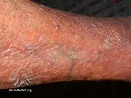 Skin thinning due to topical steroids