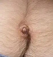 Sagittal hair growth above and below the navel