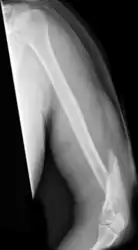 A spiral fracture of the distal one-third of the humerus shaft