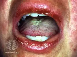 Stevens Johnson syndrome