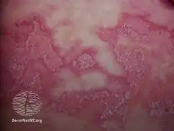 Subcorneal pustular dermatosis