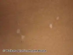 Vitiligo macules - many light macules
