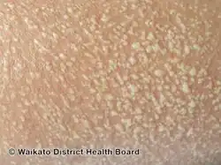 Acute generalized exanthematous pustulosis - many small spread out pustules