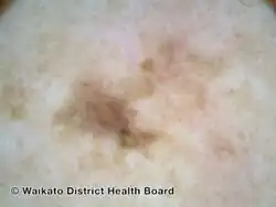 Superficial spreading melanoma, Breslow 0.7mm, arising within a melanoma in situ, nonpolarised dermoscopy view