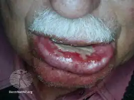 The following side effects can occur in the treated areas