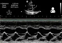 Ultrasound of peripartum cardiomyopathy