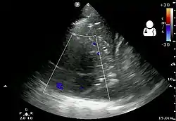 Pleural empyema as seen on ultrasound