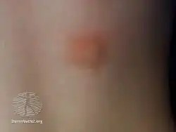 Urticaria pigmentosa