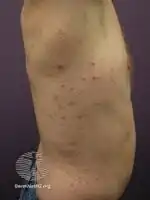 Wetsuit folliculitis