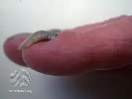 Yellow nail syndrome