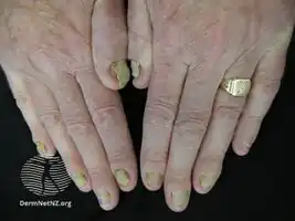 Yellow nail syndrome