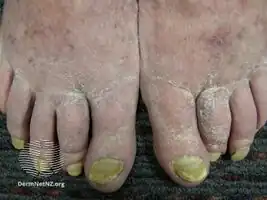 Yellow nail syndrome