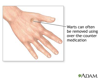 Wart removal Wart removal