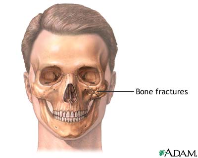 Indications Indications