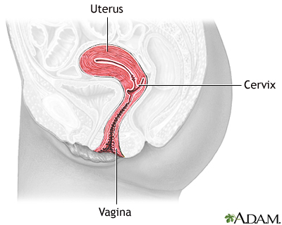 Cervical dysplasia - series Cervical dysplasia - series