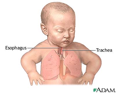 Tracheoesophageal fistula repair - series Tracheoesophageal fistula repair - series